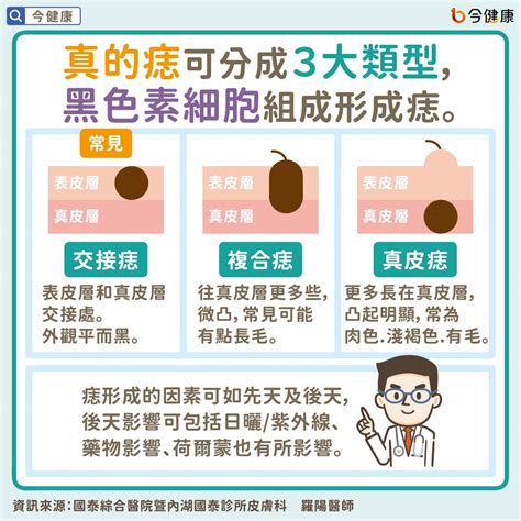 紅色的痣代表什麼|是痣？皮膚癌？還是什麼？常見Q&A解惑！醫教揪出「。